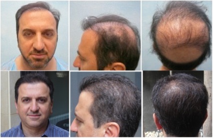 Beard Hair To Head Transplant |Patient Example|Botched Hair Transplant Repair