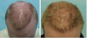beard hair transplant cost |long term satisfaction Beard Hair Transplant Cost |best hair transplant investment