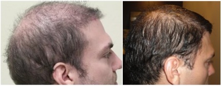Beard Hair Transplant Results|impossible repair case