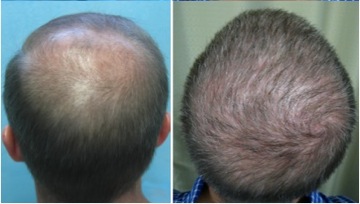 Beard Hair Transplant Results | Norwood 6 baldness