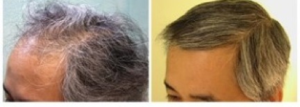 best FUE hair restoration doctor in the world |ethnic hair transplant specialization Best FUE Hair Restoration Doctor in the World |ethnic hair transplant surgery