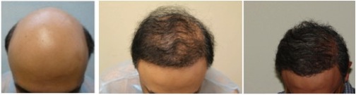 best FUE hair restoration doctor in the world |coverage for severe baldness Best FUE Hair Restoration Doctor in the World |reversing severe Norwood 7 baldness