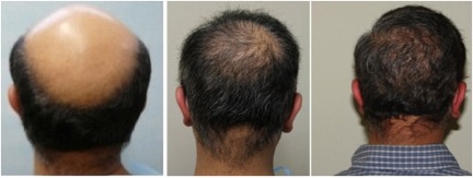 Best FUE Hair Restoration in the World perfromed by UGraft FUE|reversal of severe baldness
