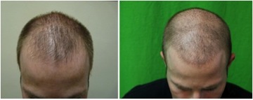 best FUE hair restoration in the world |coverage and insertions|maximizing low graft count