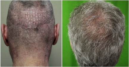 Best FUE Hair Transplant Doctor |punch graft scars|hair transplant repair