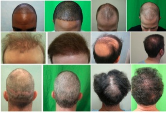 Worlds Best FUE Hair Transplant Doctor|patient cases
