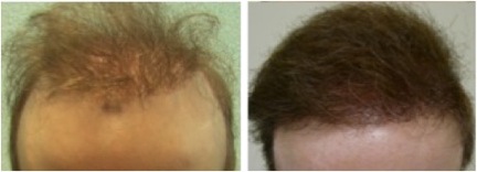 Best FUE Hair Transplant Surgeon in the World |challenging repair