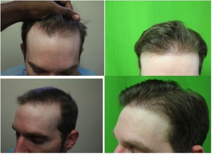 Best FUE Hair Transplant Surgeon in the World |patient photos
