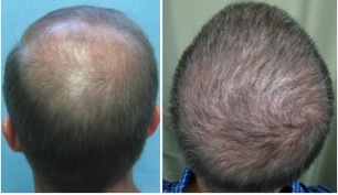 Best Hair Restoration Doctor in the World | restoring crown area