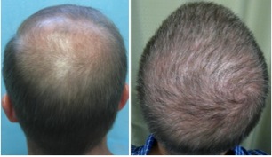 best hair restoration doctor in the world | using body hair to fill the crown Best Hair Restoration Doctor in the World | restoring crown area