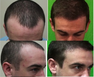 best hair restoration surgeon in the world | hairline detail