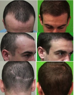 best hair transplant doctor in the world |meeting patient goals Best Hair Transplant Doctor in the World | undetectable results