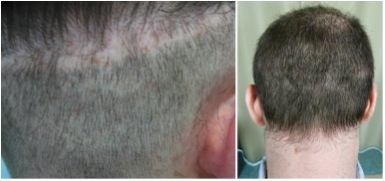best hair transplant in the world | how to hide a strip scar Best Hair Transplant in the World | repairing strip scar
