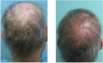 Body Hair Transplant Images |repair of botched hair restoration