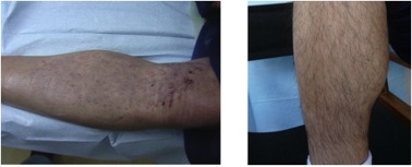 Body Hair Transplant Images |leg hair grafts- post surgical healing