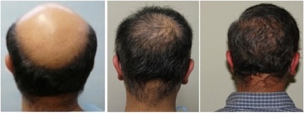 Body Hair Transplant Images | severe baldness