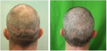 Body Hair Transplant Photos|concealing strip scars