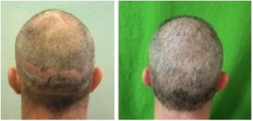 body hair transplant photos|best coverage for strip scar repair Body Hair Transplant Photos|concealing strip scars