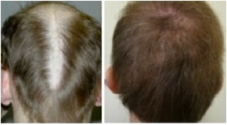 body hair transplant photos| slot formation repair Body Hair Transplant Photos| concealing slot formation