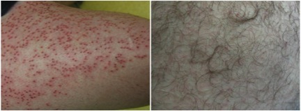 Body Hair Transplant Photos|donor wound healing