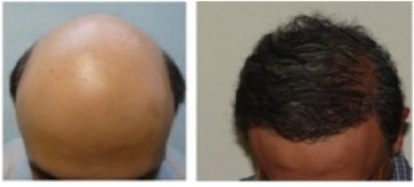 Body Hair Transplant Photos| surgery for severe baldness