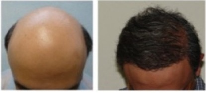 body hair transplant photos| hair restoration for severe baldness Body Hair Transplant Photos| surgery for severe baldness