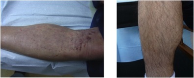 body hair transplant surgery |grafts from leg Body Hair Transplant Surgery|leg hair grafts