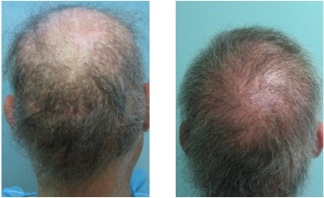 body hair transplant surgery |impossible repair case Body Hair Transplant Surgery|Concealing punch scars & strip scars