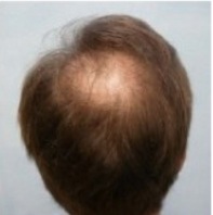 crown hair transplant|baldness in the crown Crown Hair Transplant|restoration surgery