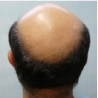 crown hair transplant|severe Norwood 7 baldness Crown Hair Transplant|severe baldness