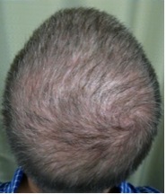 crown hair transplant| reconstructing crown whorl Crown Hair Transplant| restoring whorl