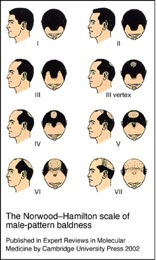 Hair Restoration Videos| Levels of Hair Loss