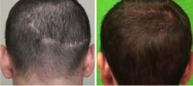 Hair Transplant Cost Info|Strip Scar Repair