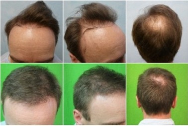 Hair Transplant Los Angeles|hair transplant repair| front & back view Hair Transplant Los Angeles|Repair of botched surgery