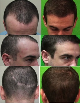 Hair Transplant Images|hair loss in the temples & hairline