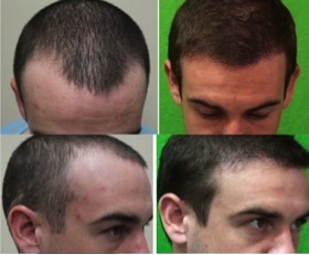 Hairline Recession, before and after UGraft hair restoration surgery