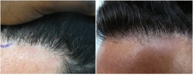 Hairline Recession|use of leg hair grafts for softness