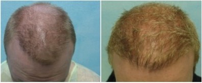 Hairline Recession| Repairing Poor Hairline Restoration Results