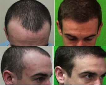 hairline reconstruction| Aesthetic Facial Balance Hairline Reconstruction| Facial Frame - Younger Hair Transplant Patient