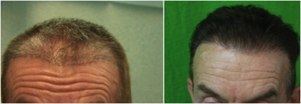 Hairline Reconstruction|satisfied patient
