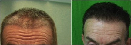 hairline reconstruction|correcting uneven growth from past hair transplant surgery Hairline Reconstruction|satisfied patient