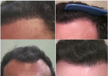 Hairline Repair 3