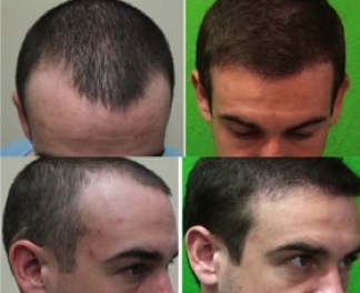 Hairline Restoration|Young Patient - FUE