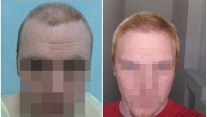 Hairline Transplant |Repair Surgery Through FUE