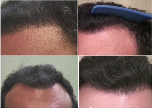 Hairline Transplant | FUE Surgery| Natural looking results