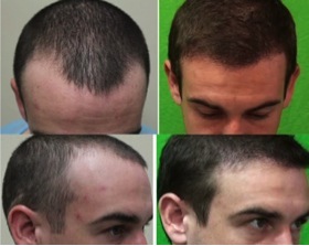 receding hairline|patient's before & after images Receding Hairline|best hairline restoration