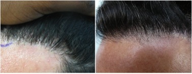 Receding Hairline| use of leg hair grafts