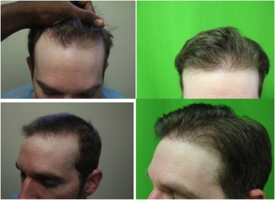 Receding Hairline 5