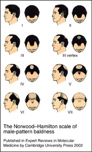 Severe Hair Loss|progressive baldness & hair loss
