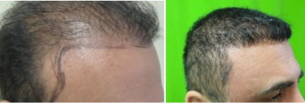 Temple Point Restoration |Patient Results